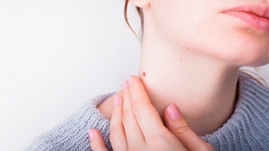 Preventivo Melanoma-Cáncer de Piel